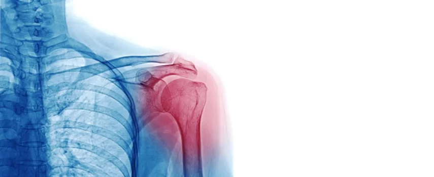 lesiones en el hombro y los acuerdos de compensacion laboral